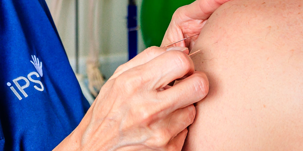 Acupuncture for Bell's Palsy